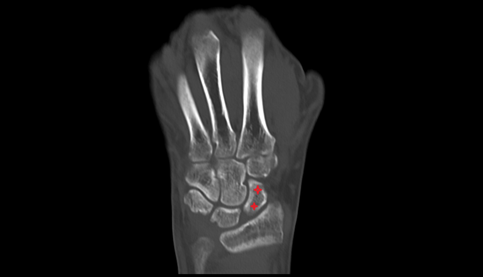 Scaphoid ct coronal image