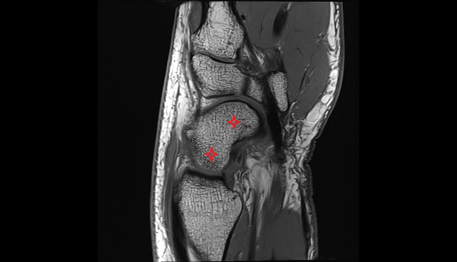 Scaphoid sag cross sectional anatomy 3T MRI AI enhanced radiology image-img-00000-00000