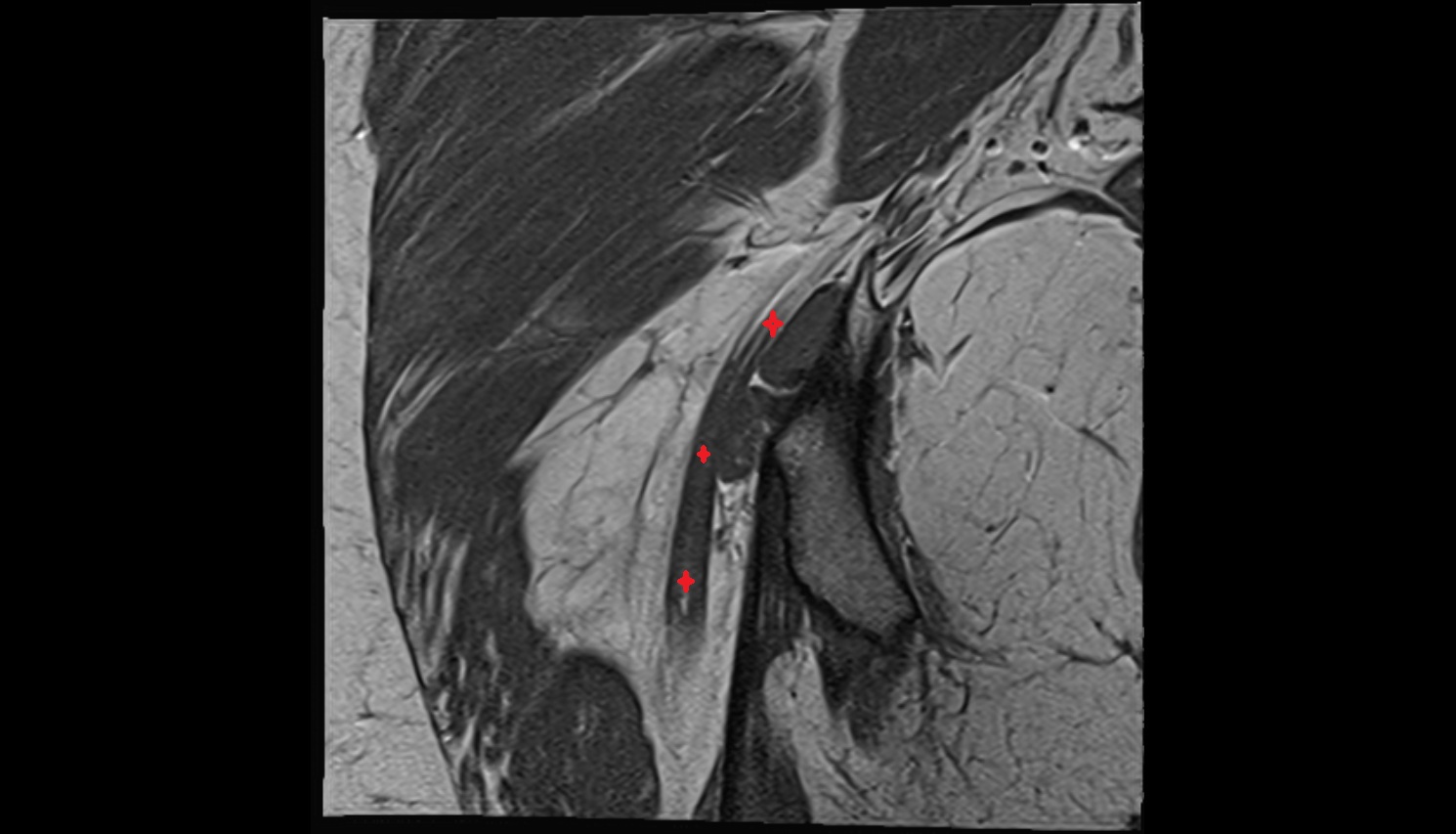 Sciatic nerve  MRI CORONAL  anatomy image-img-00000-00000