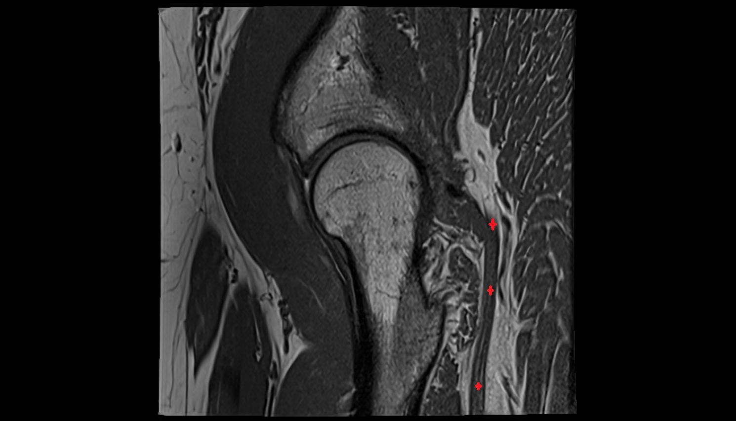 Sciatic nerve  MRI SAG  anatomy image-img-00000-00000