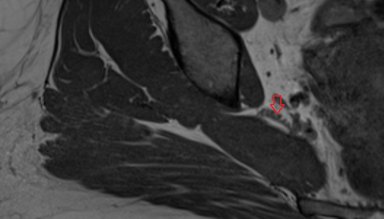 Sciatic nerve  MRI  axial  anatomy  image-img-00000-00000