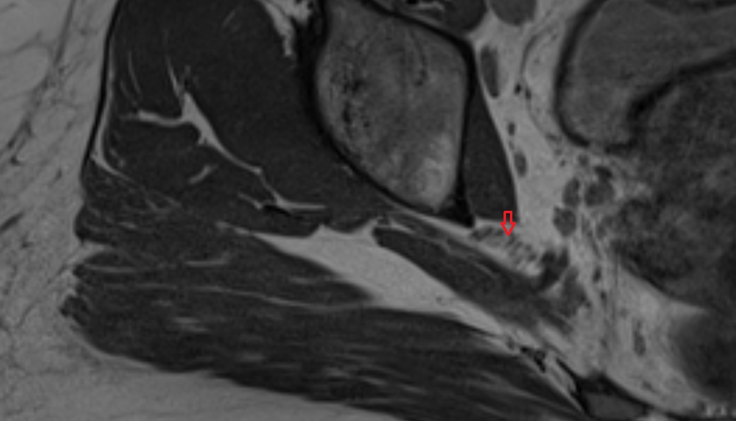 Sciatic nerve  MRI  axial  anatomy  image-img-00000-00000_00001