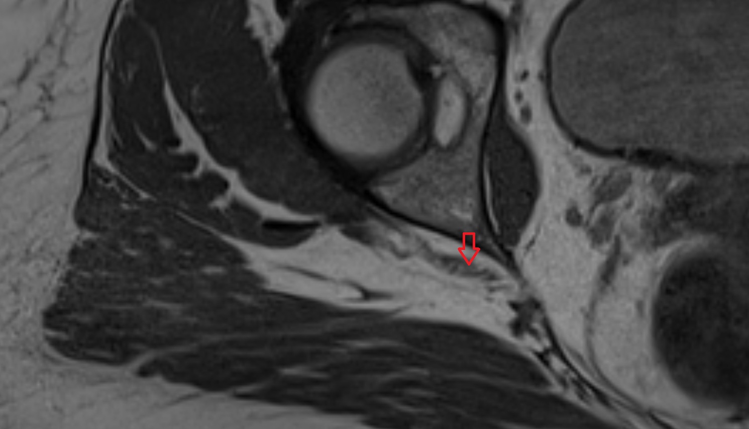 Sciatic nerve  MRI  axial  anatomy  image-img-00000-00000_00002