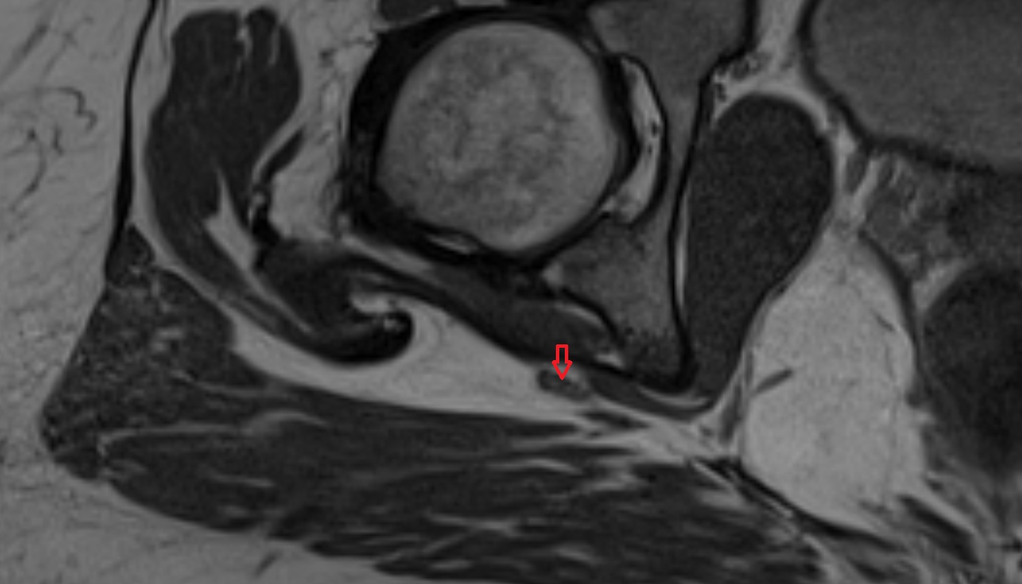 Sciatic nerve  MRI  axial  anatomy  image-img-00000-00000_00003
