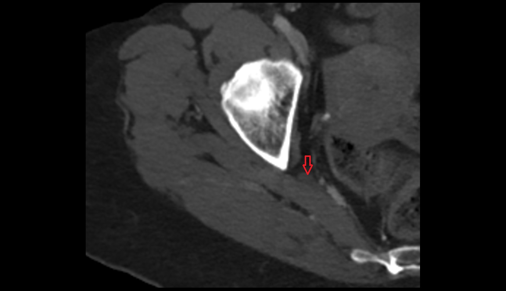 Sciatic nerve ct axial image 0