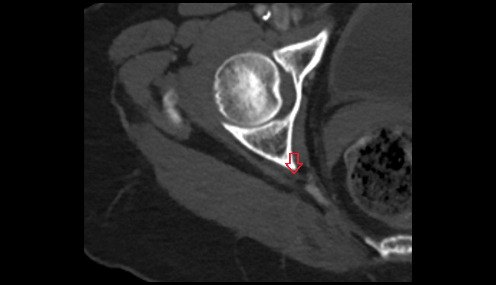 Sciatic nerve ct axial image 1