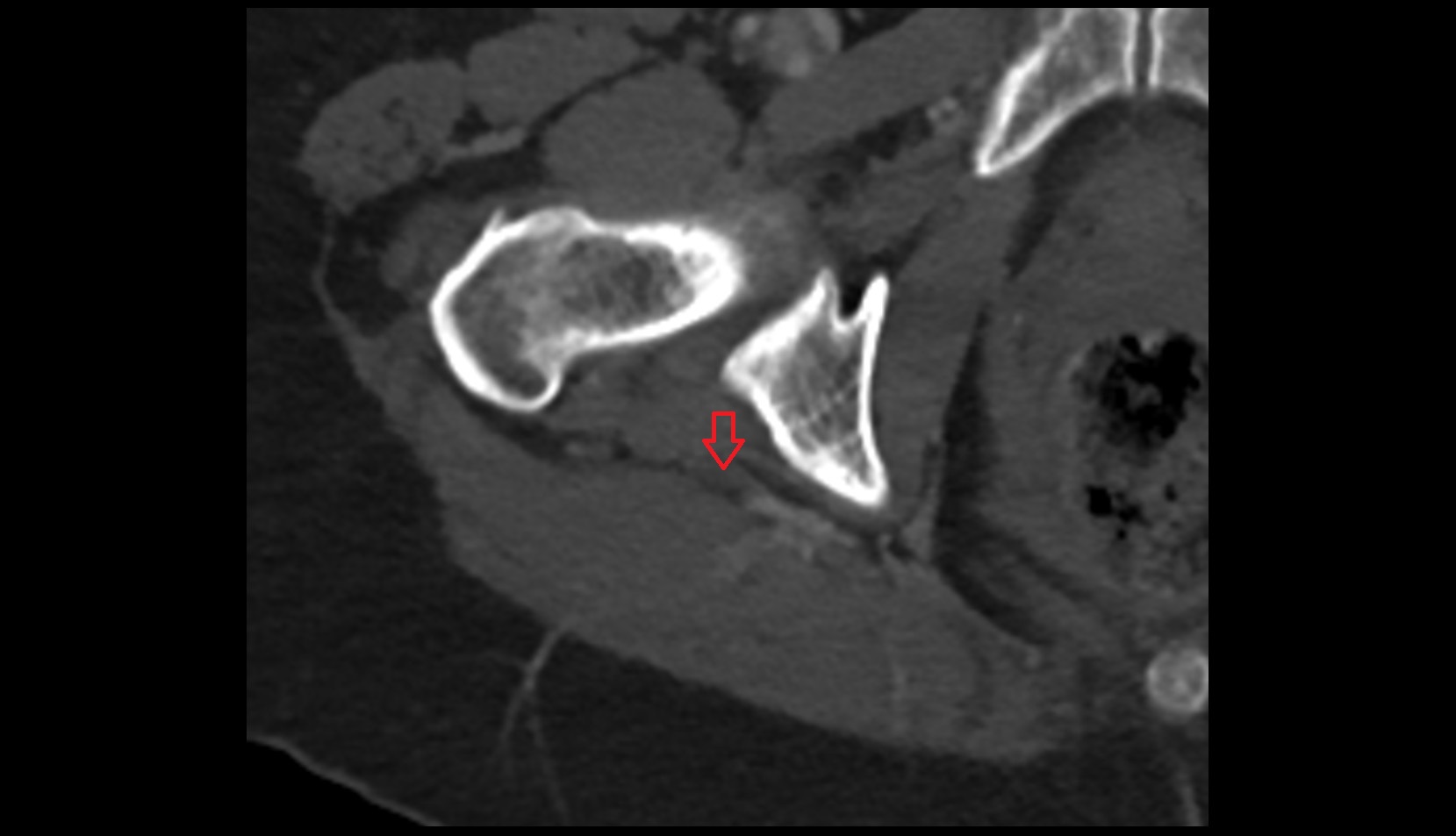 Sciatic nerve ct axial image 2