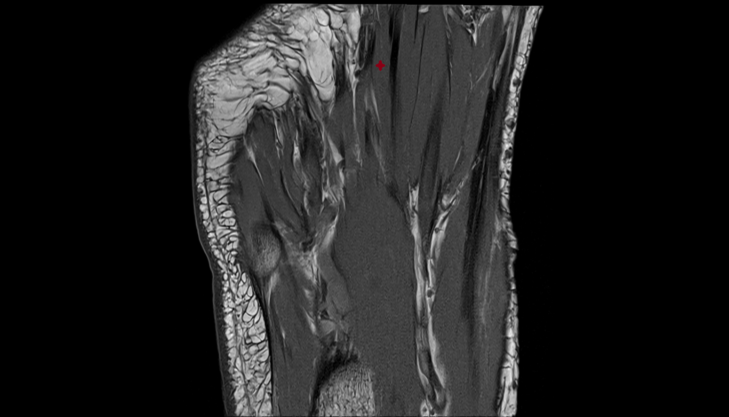 Second Lumbrical Muscle of Foot  axial cross sectional anatomy 3T MRI AI enhanced radiology image-img-00000-00000