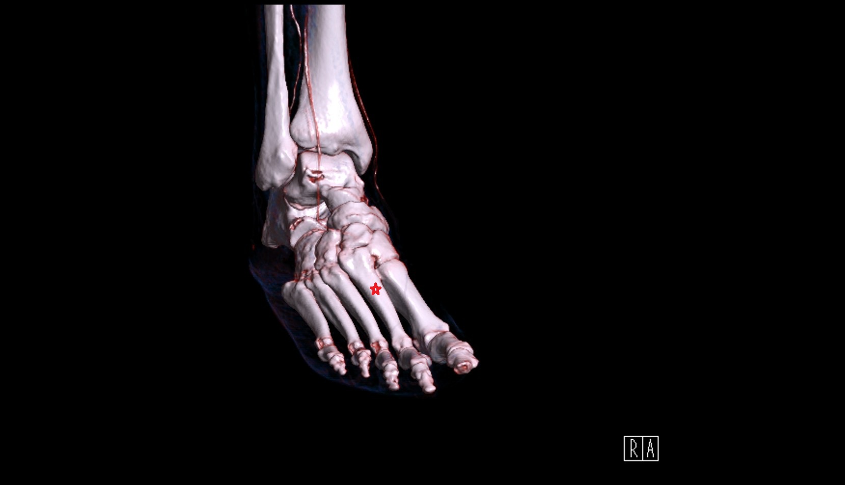 Second Metatarsal Bone ct 3d vrt image