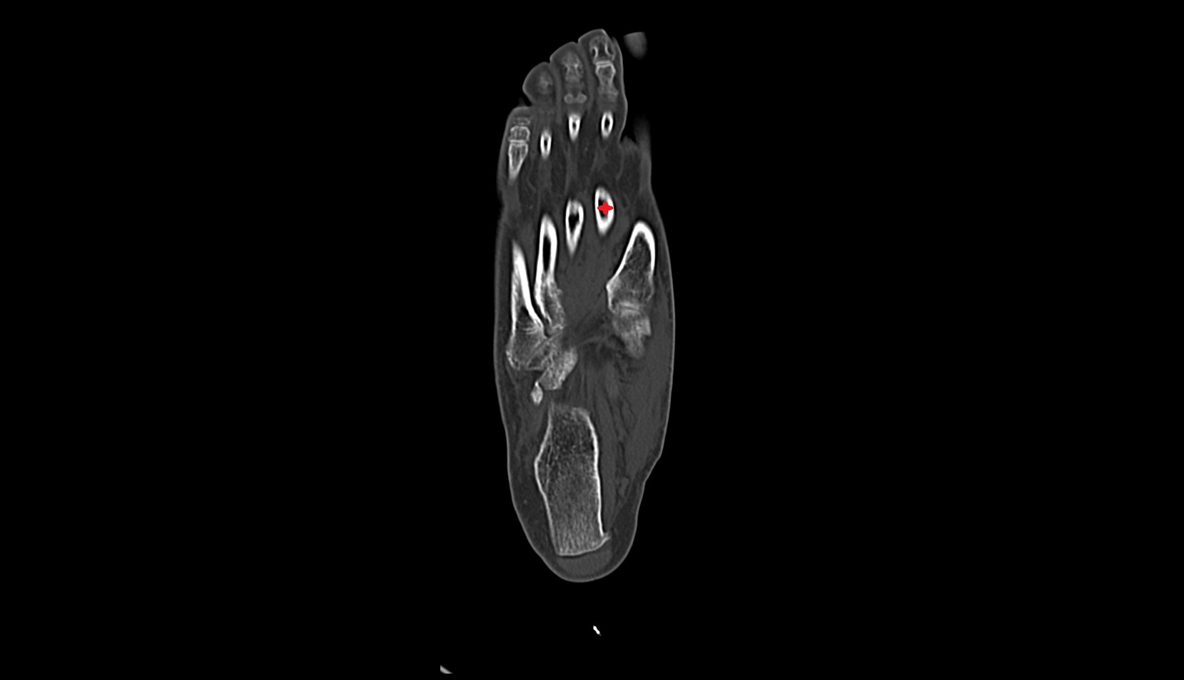 Second Metatarsal Bone ct axial