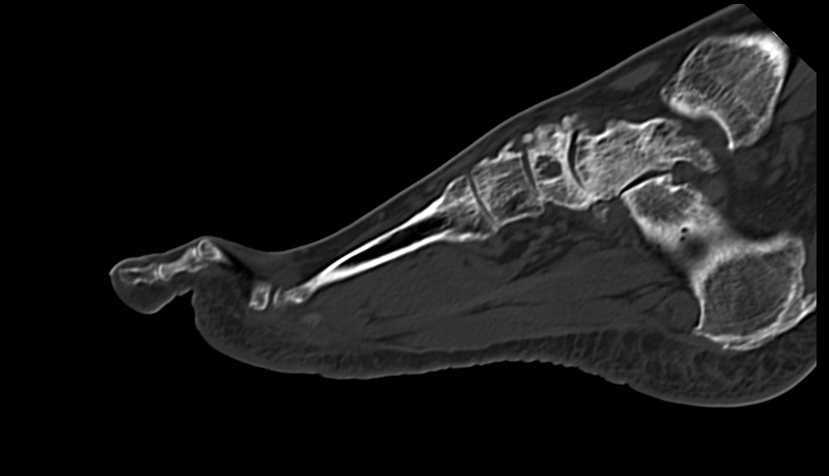 Second Metatarsal Bone ct sag image