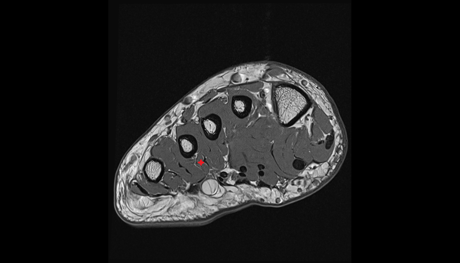 Second Plantar Interosseous Muscle  of foot  axial cross sectional anatomy 3T MRI AI enhanced radiology image-img-00000-00000