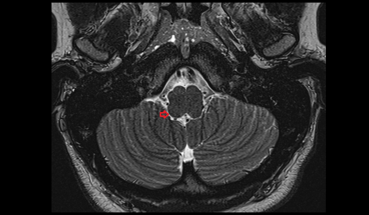 Secondary fissure MRI 3T axial image