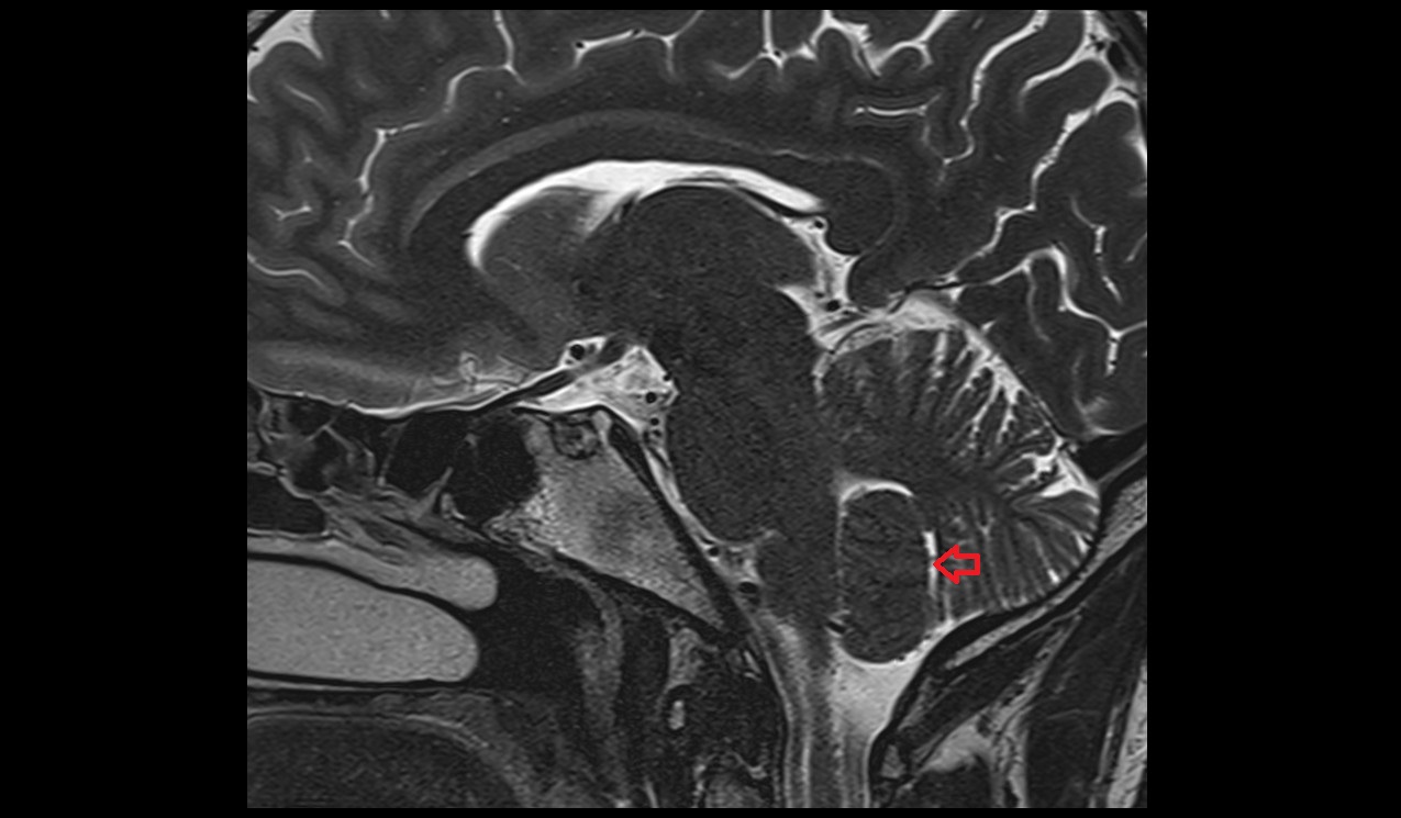 Secondary fissure MRI 3T sagittal image