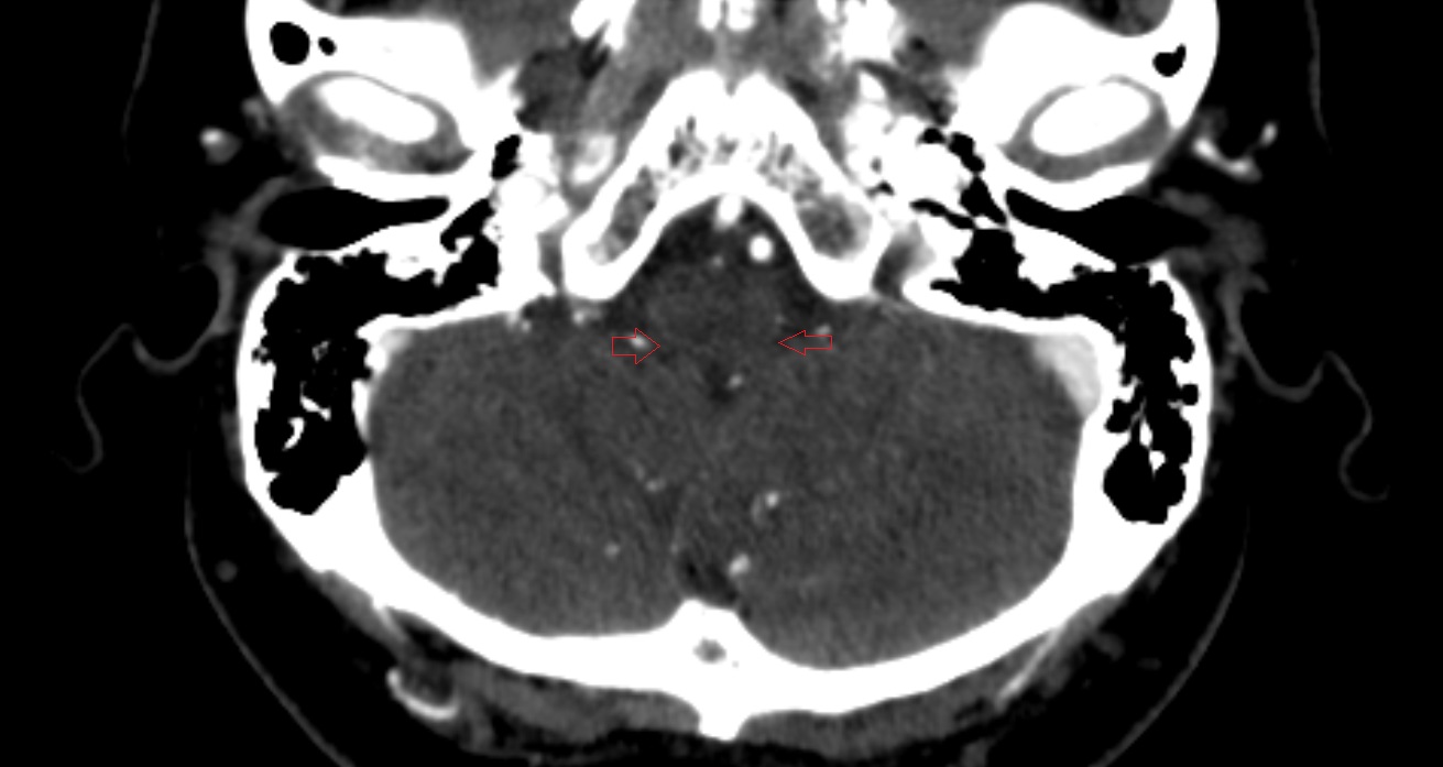 Secondary fissure of cerebellum  CT sag  anatomy image -img-00001-00001