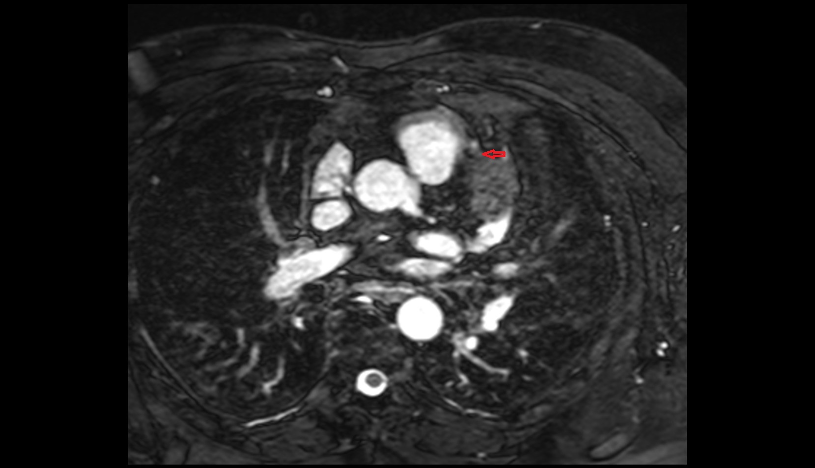 Second diagonal branch (D2) of LAD mri axial