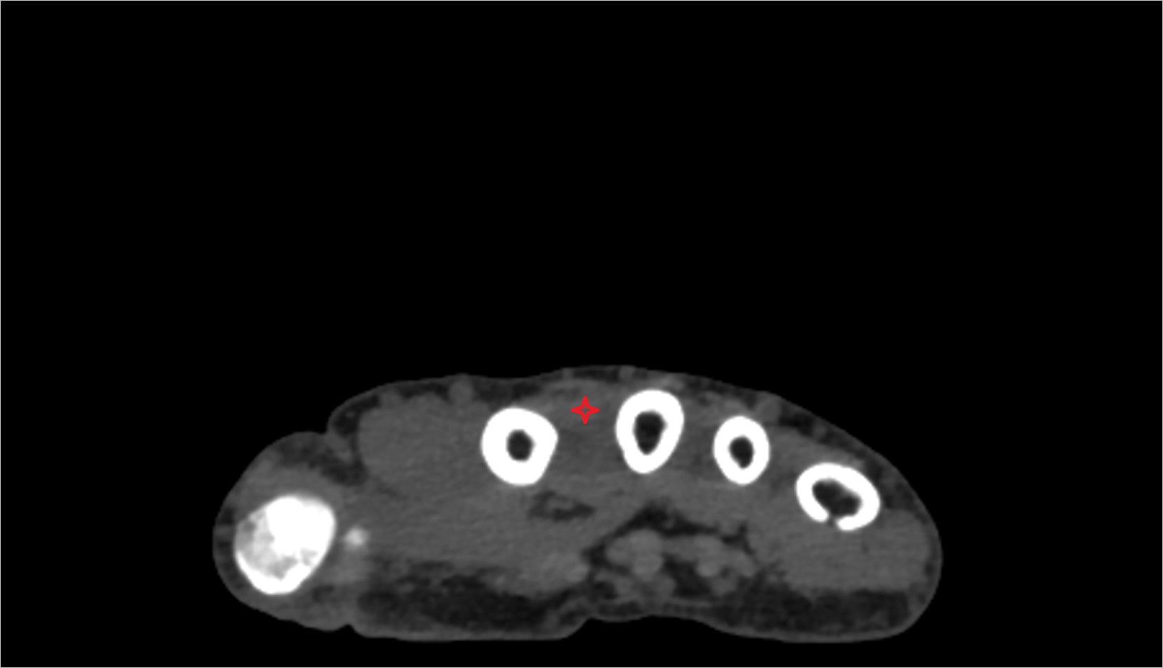 Second dorsal interosseous muscle ct image