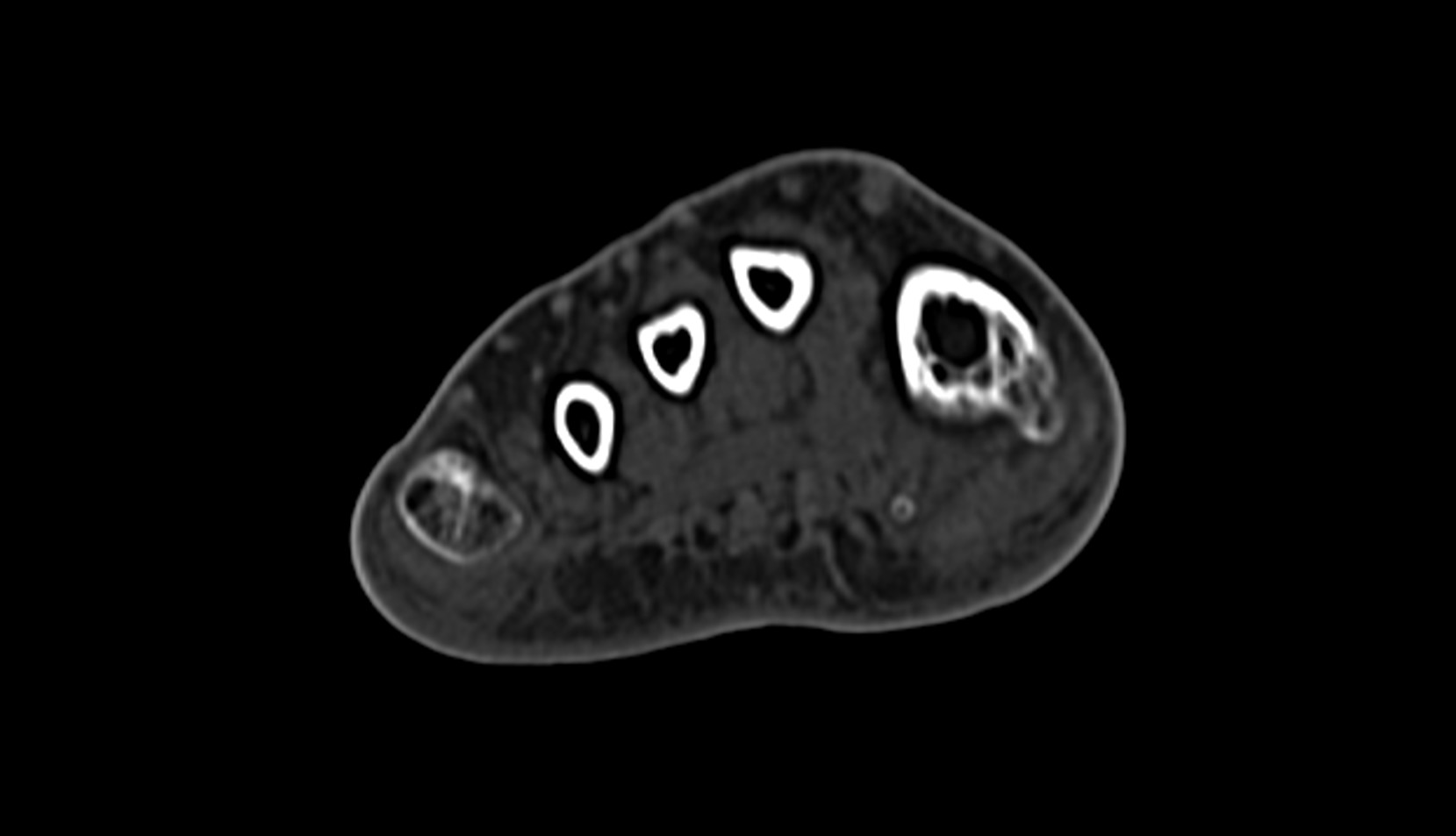 Second dorsal interosseous muscle of foot CT axial