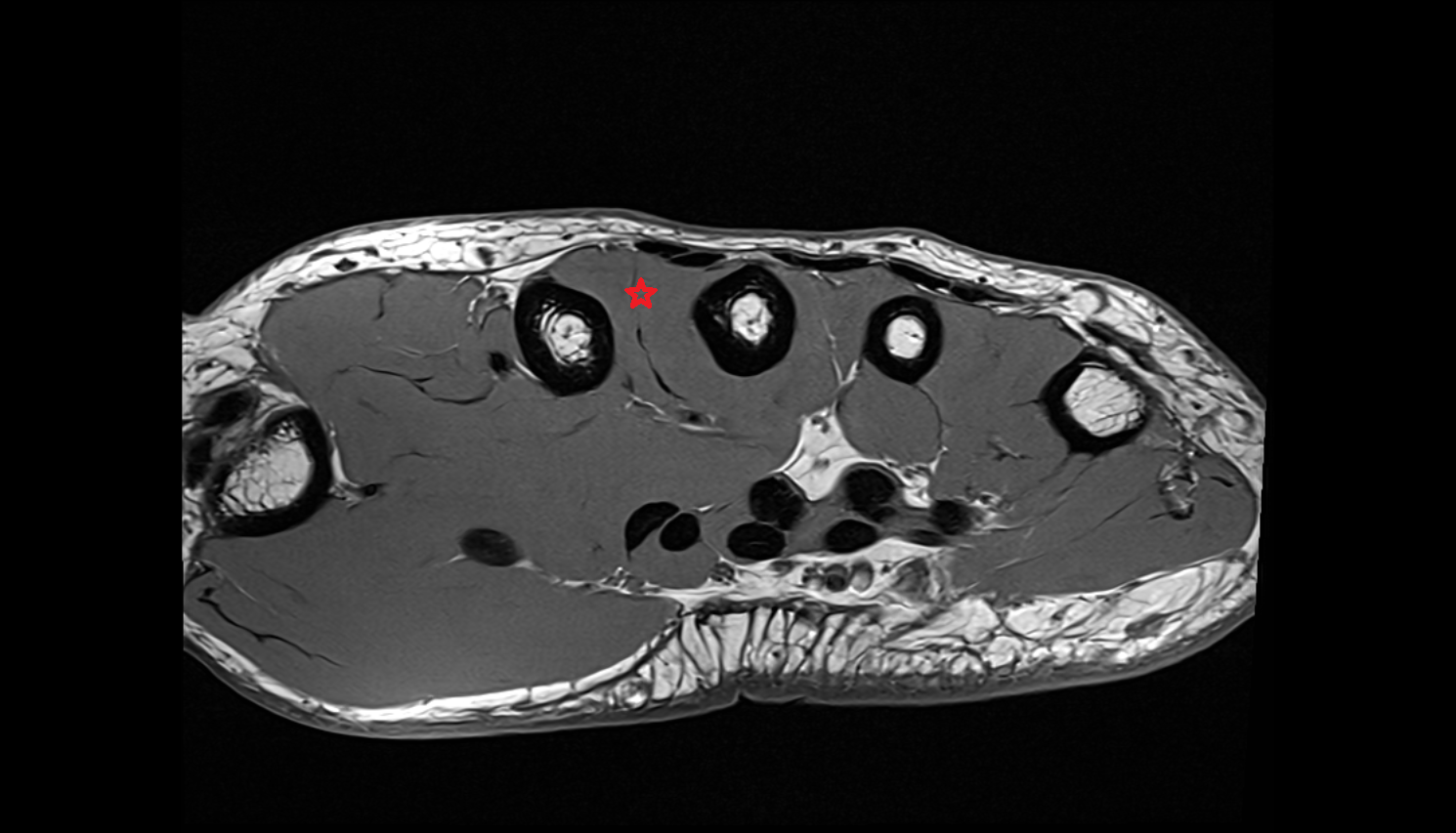 Second dorsal interosseous muscle of hand of hand axial cross sectional anatomy 3T MRI AI enhanced radiology image-img-00000-00000
