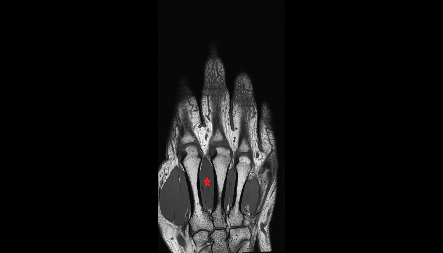 Second dorsal interosseous of hand of hand coronal cross sectional anatomy 3T MRI AI enhanced radiology image-img-00000-00000