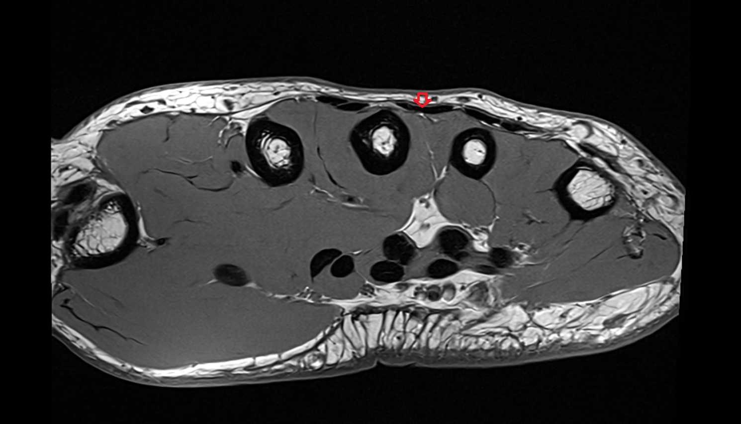 Second extensor digitorum tendon (Extensor digitorum tendon to middle finger)  axial cross sectional anatomy 3T MRI AI enhanced radiology image-img-00000-00000