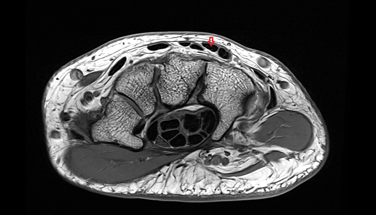 Second extensor digitorum tendon (Extensor digitorum tendon to middle finger)  axial cross sectional anatomy 3T MRI AI enhanced radiology image-img-00000-00000_00001
