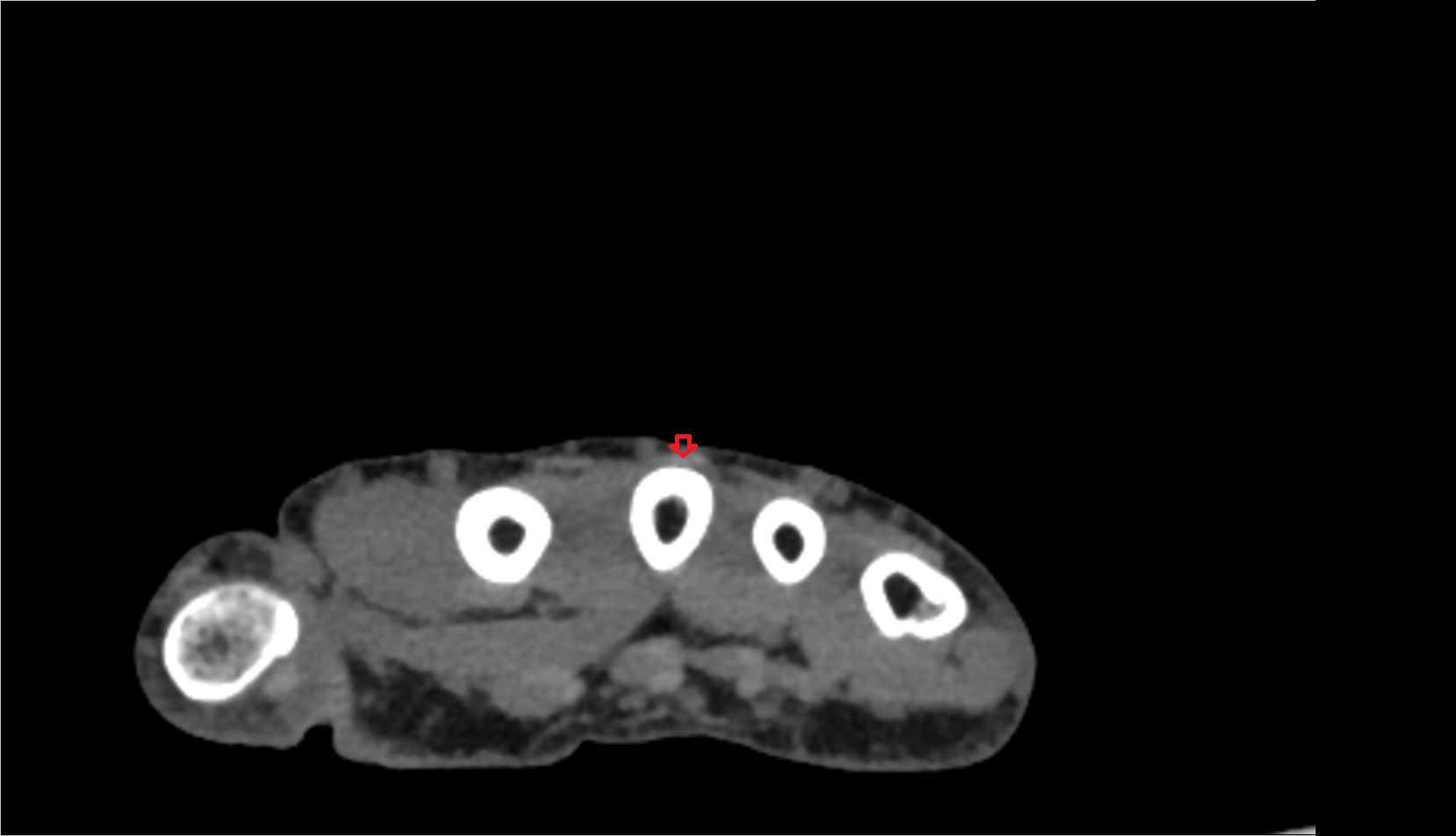 Second extensor digitorum tendon (Extensor digitorum tendon to middle finger) ct axial