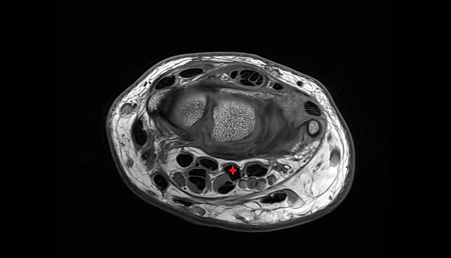 Second flexor digitorum profundus tendon (middle)  axial cross sectional anatomy 3T MRI AI enhanced radiology image-img-00000-00000_00001