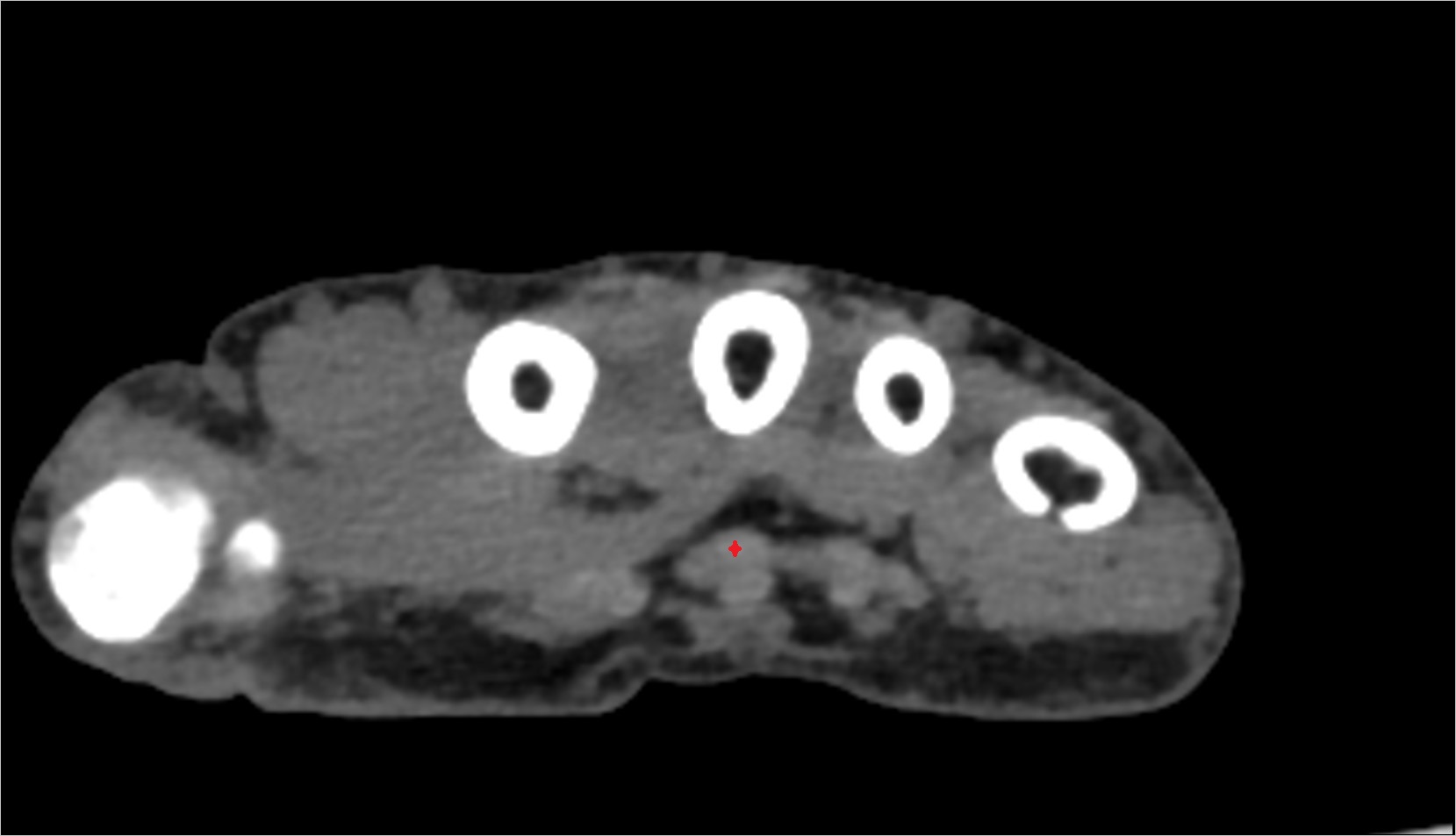 Second flexor digitorum profundus tendon (middle) ct image