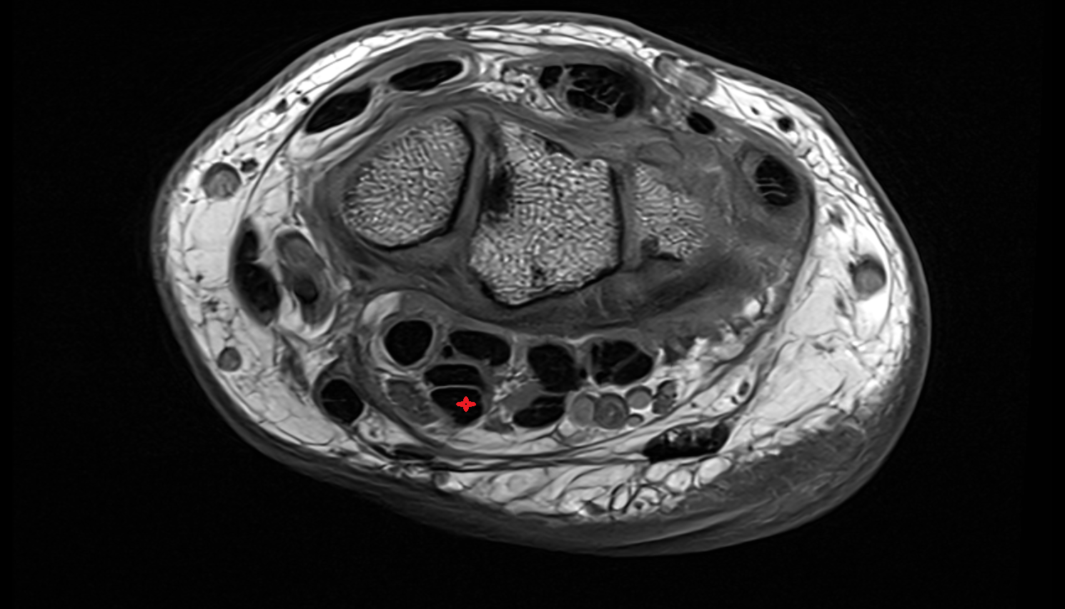Second flexor digitorum superficialis tendon (middle) axial cross sectional anatomy 3T MRI AI enhanced radiology image-img-00000-00000_00001