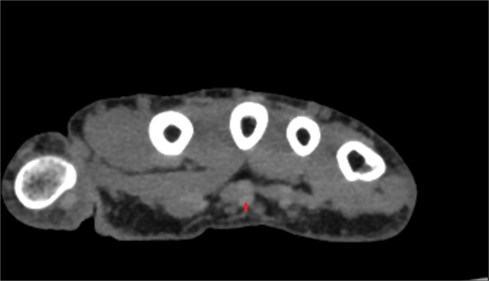 Second flexor digitorum superficialis tendon (middle) ct axial