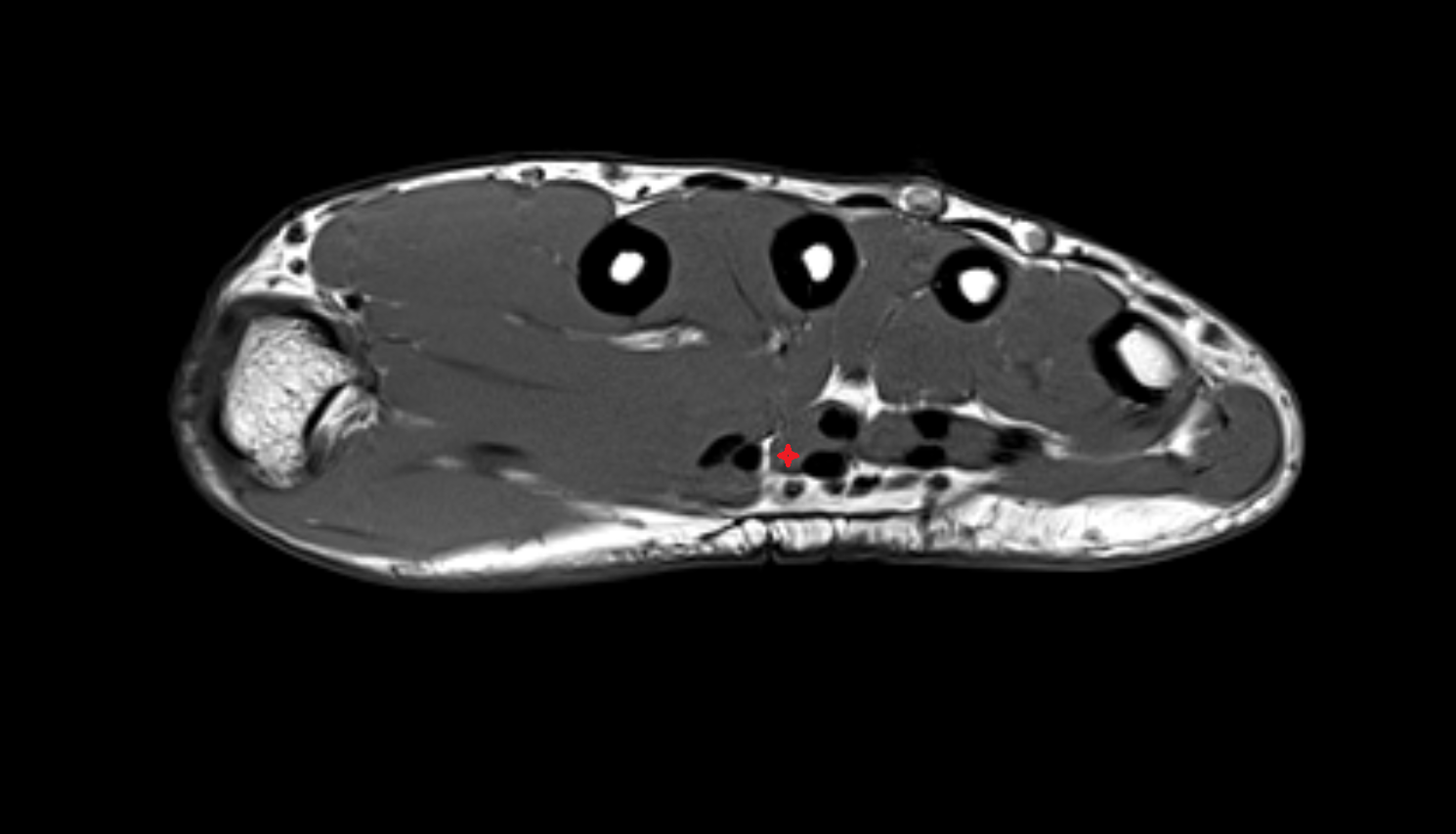 Second lumbricall  muscle of hand of hand axial cross sectional anatomy 3T MRI AI enhanced radiology image-img-00000-00000