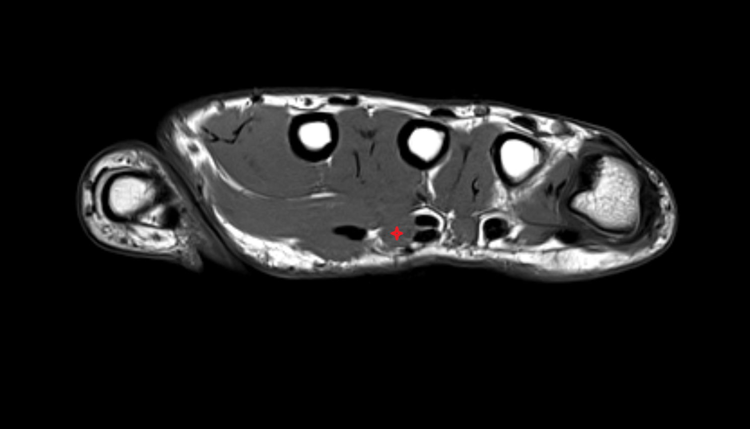 Second lumbricall  muscle of hand of hand axial cross sectional anatomy 3T MRI AI enhanced radiology image-img-00000-00000_00001