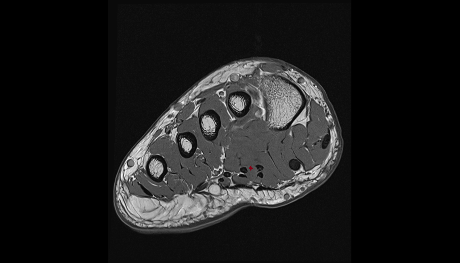 Second lumbrical muscle of Foot  axial cross sectional anatomy 3T MRI AI enhanced radiology image-img-00000-00000_00002