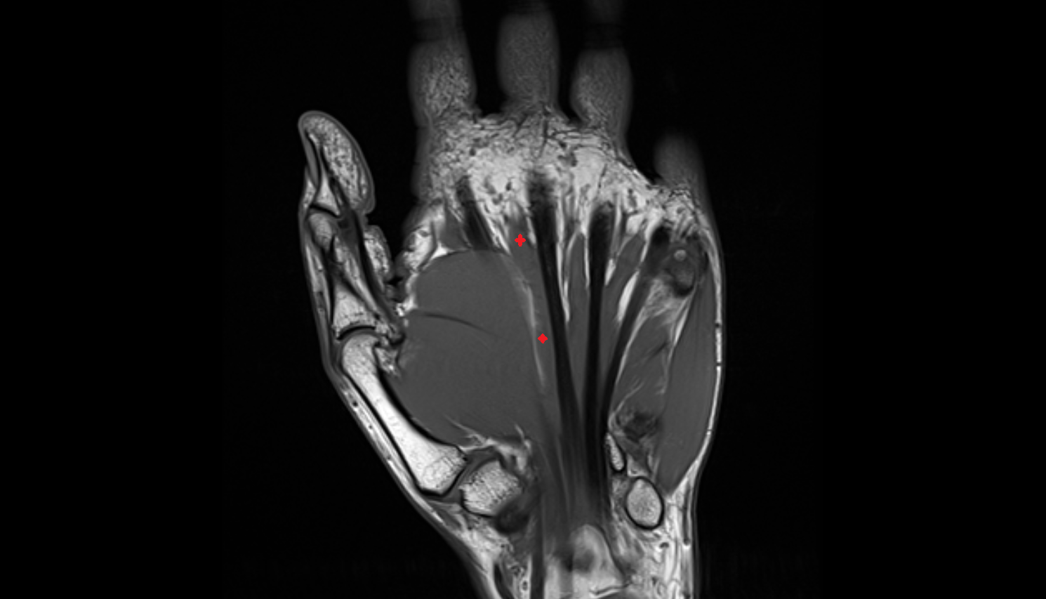 Second lumbrical  muscle of hand of hand coronal cross sectional anatomy 3T MRI AI enhanced radiology image-img-00000-00000
