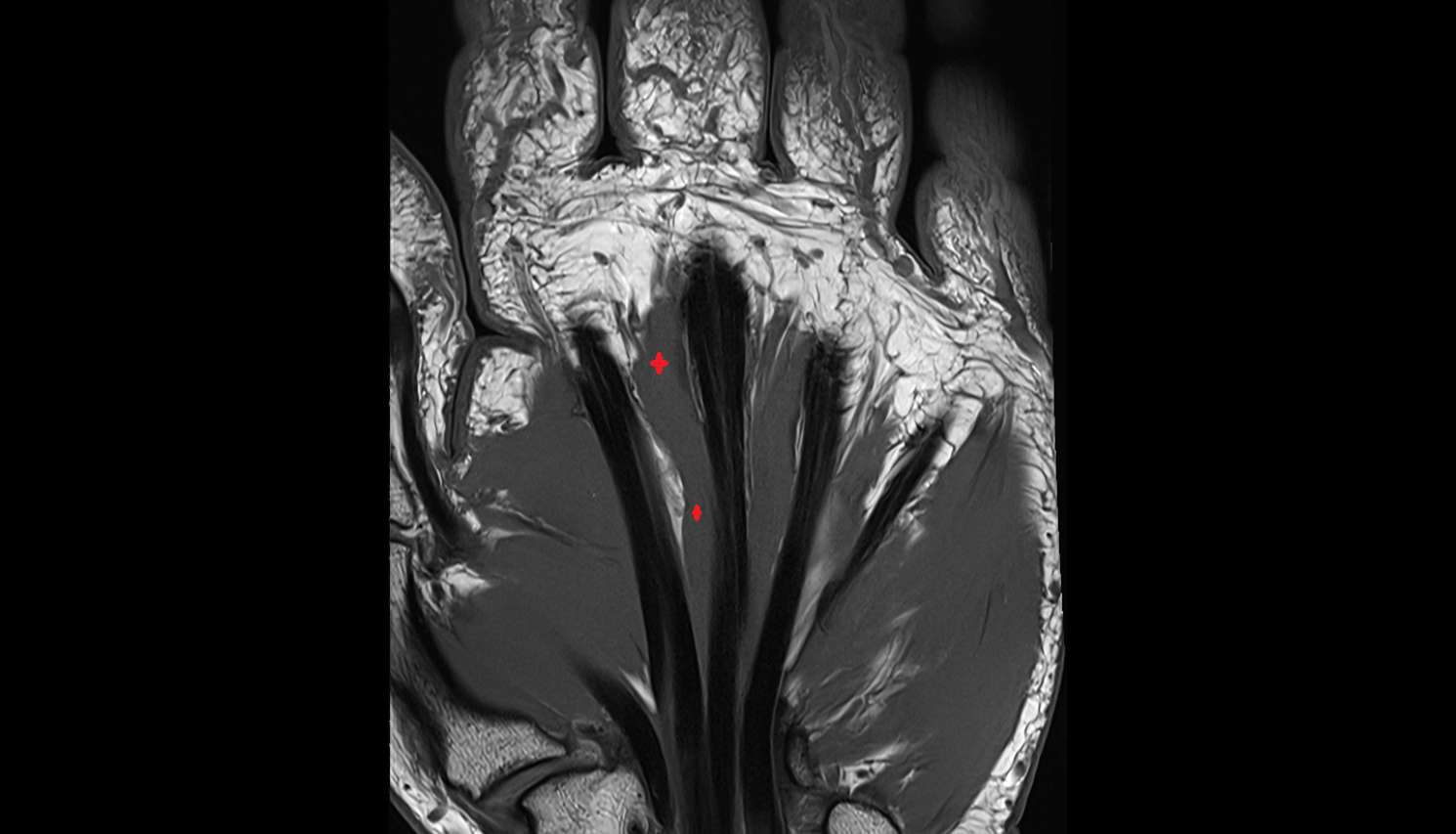 Second lumbrical  muscle of hand of hand coronal cross sectional anatomy 3T MRI AI enhanced radiology image-img-00000-00000_00001