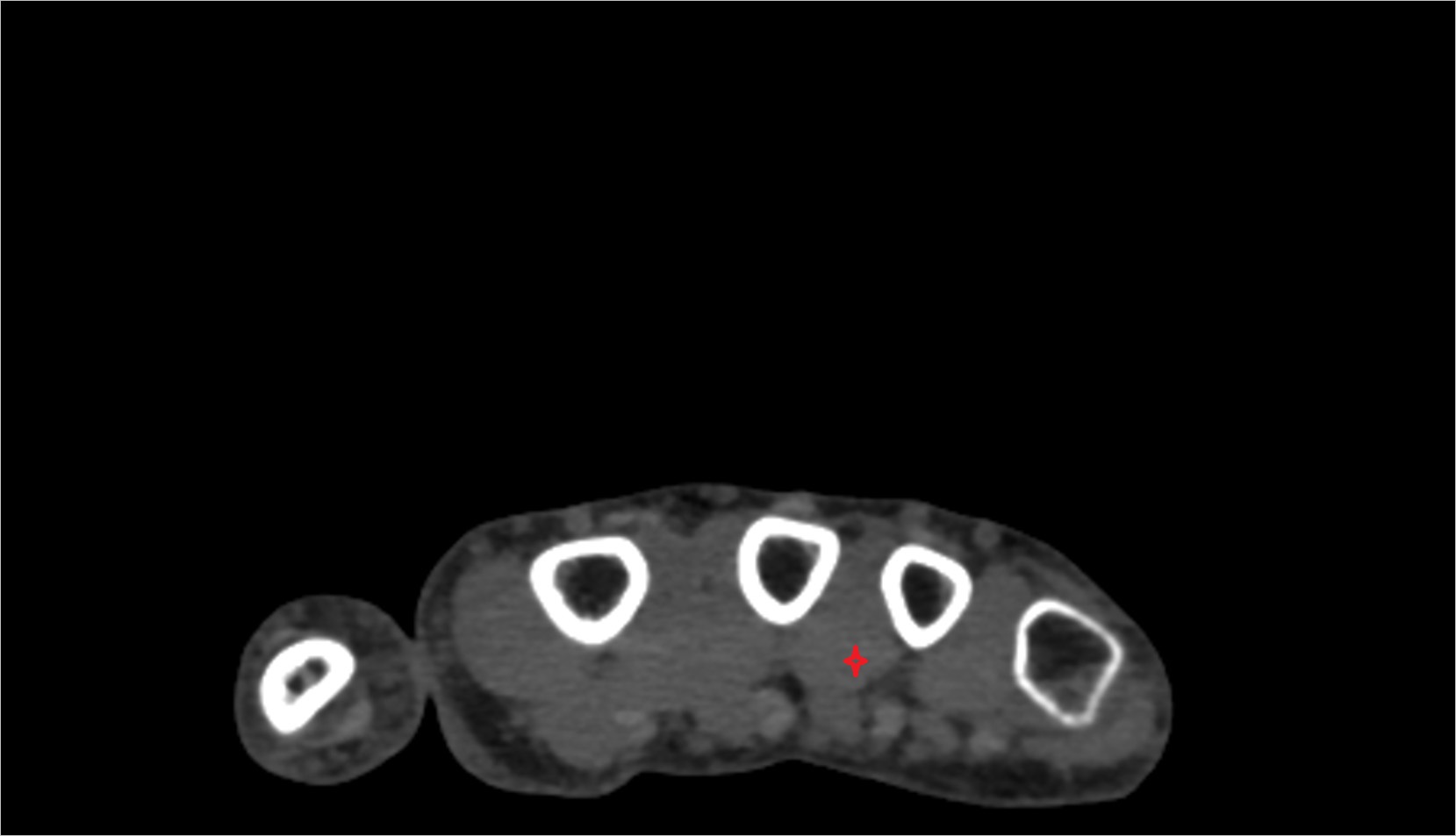 Second plantar (palmar) interosseous muscle ct axial image