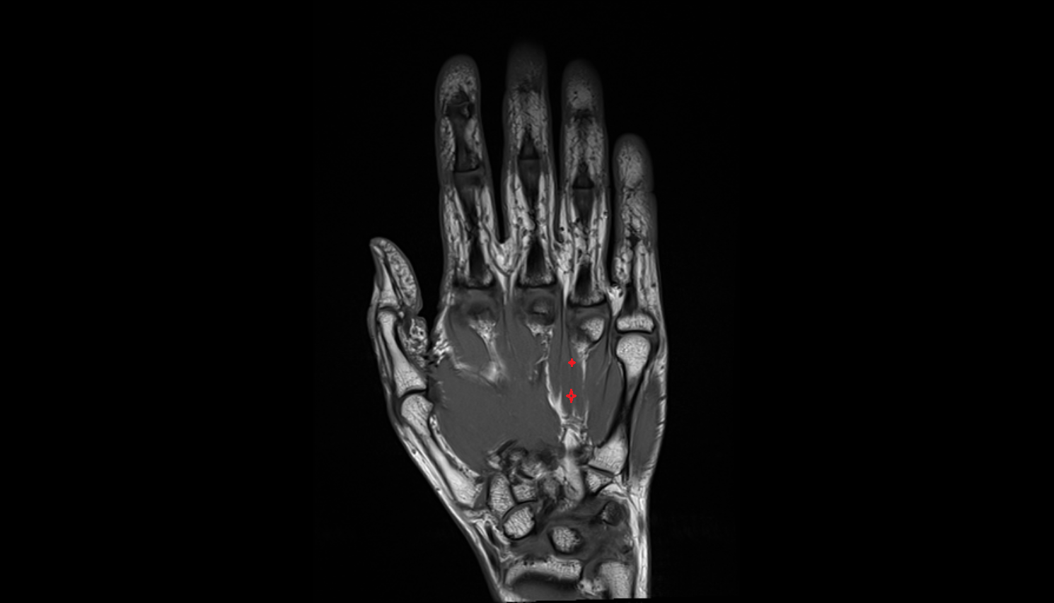 Second plantar (palmar) interosseous muscle of hand of hand axial cross sectional anatomy 3T MRI AI enhanced radiology image-img-00000-00000
