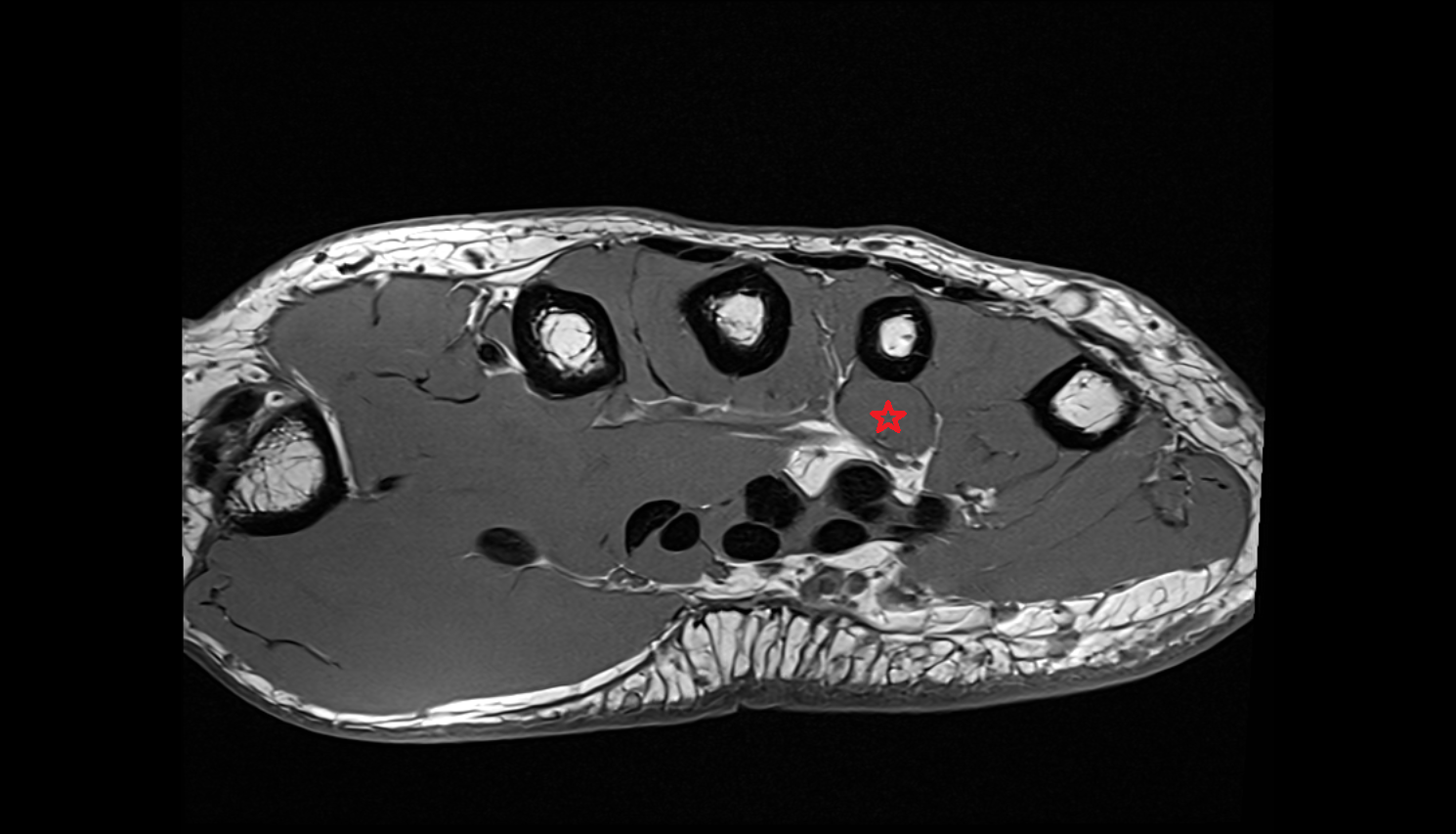 Second plantar (palmar) interosseous muscle of hand of hand axial cross sectional anatomy 3T MRI AI enhanced radiology image-img-00000-00000_00001