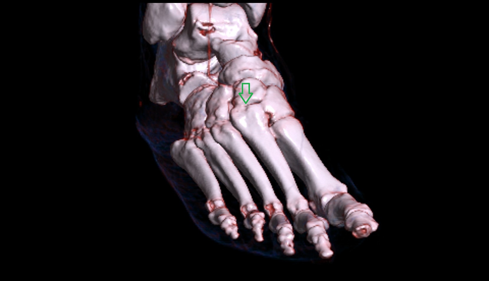 Second tarsometatarsal joints 3d