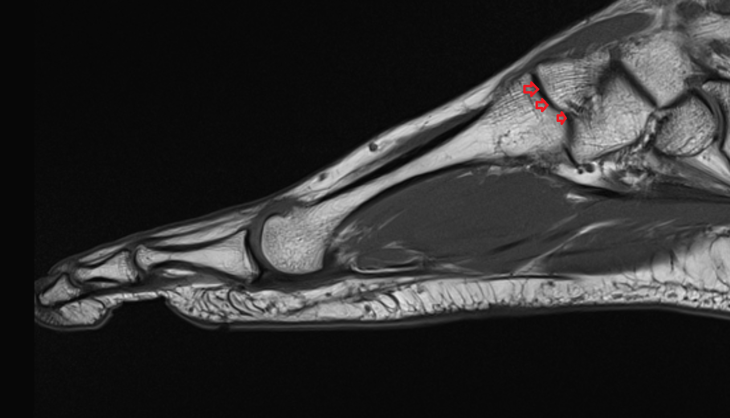 Second tarsometatarsal joints mri  anatomy labelled image-img-00000-00000