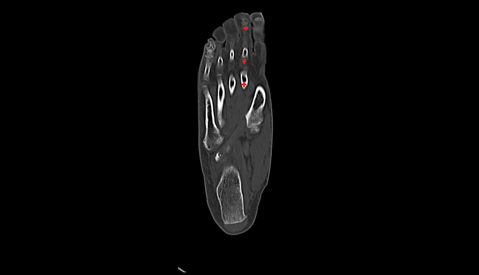 Second toe CT coronal image