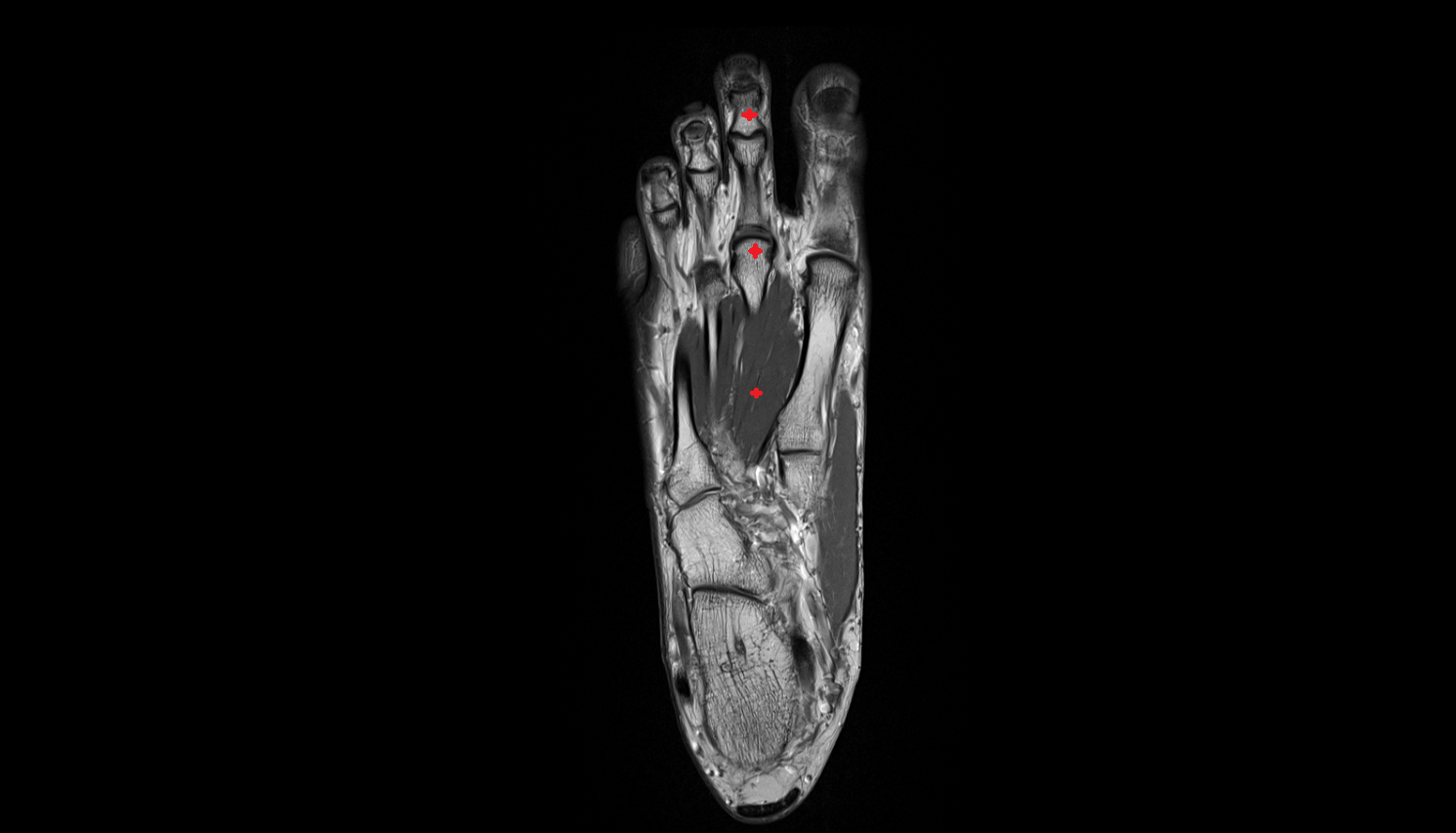 Second toe of foot axial cross sectional anatomy 3T MRI AI enhanced radiology image-img-00000-00000