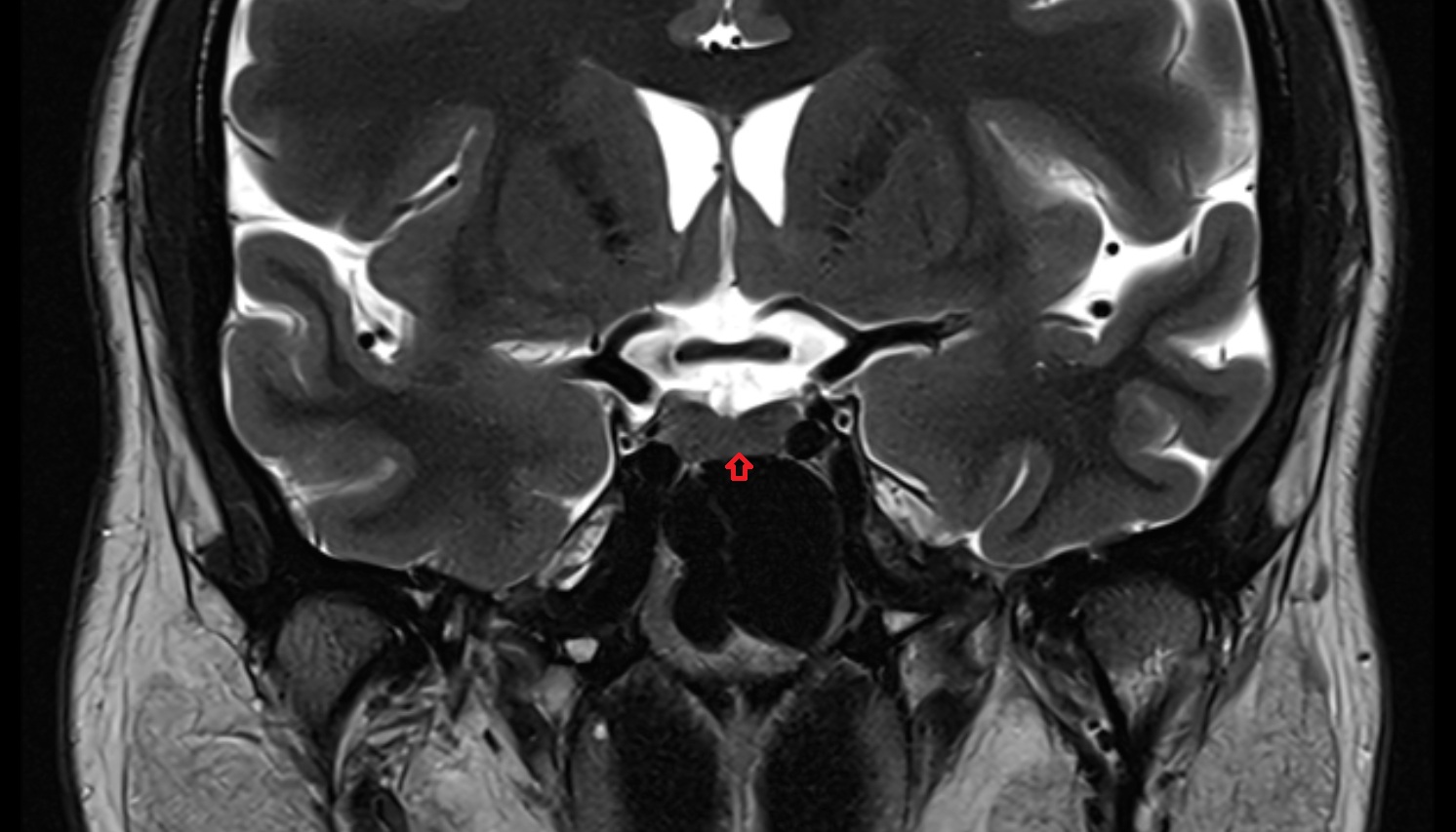 Sella Turcica  mri coronal image -img-00000-00000