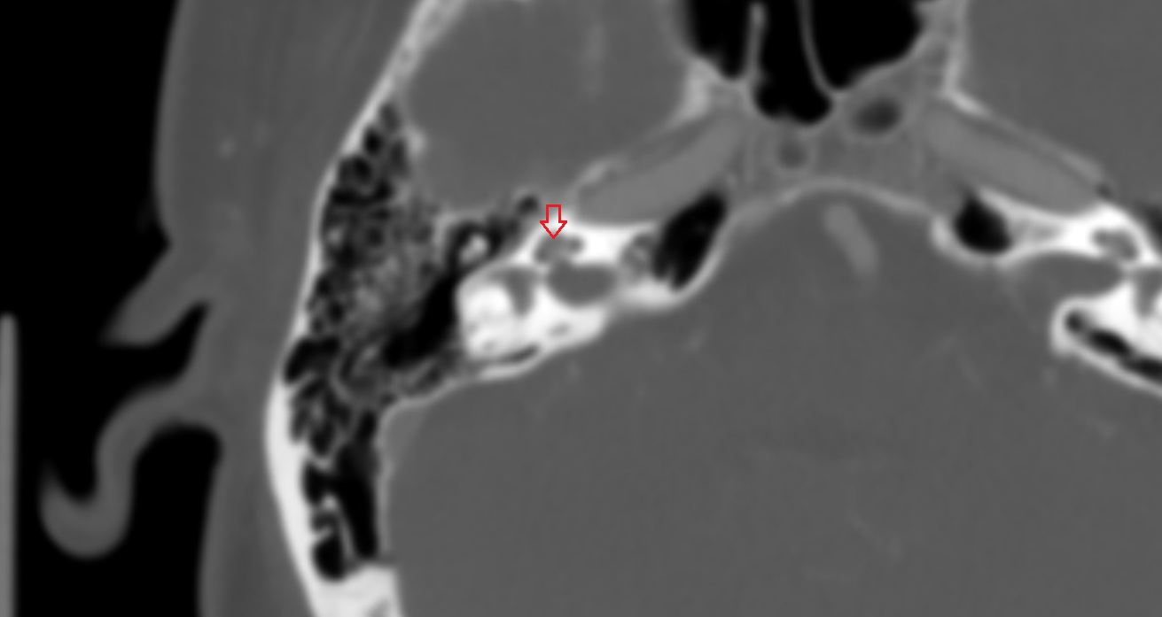Semicircular Canals CT axial anatomy image -img-00001-00001