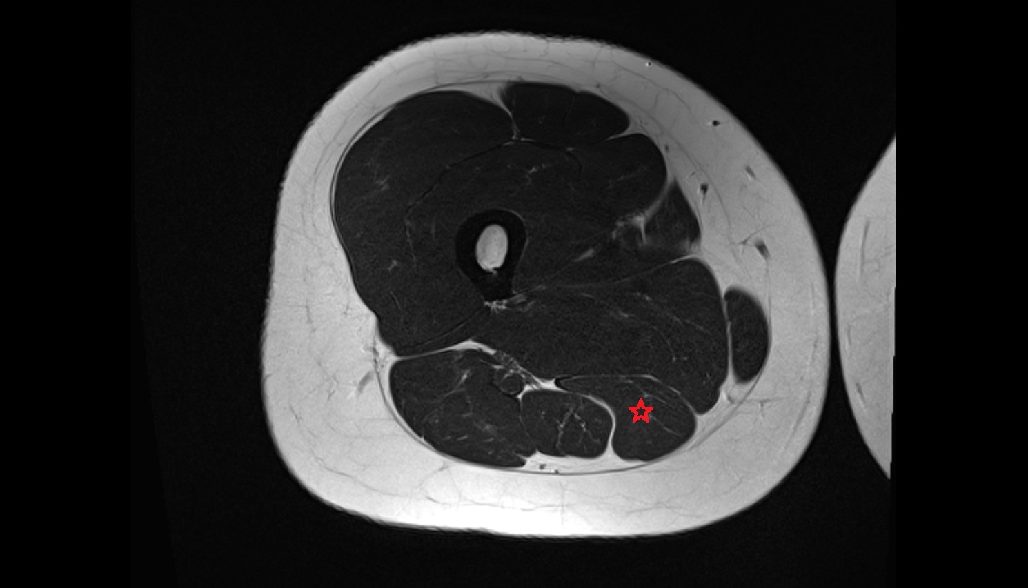 Semimembranosus muscle  MRI AXIAL anatomy image-img-00000-00000