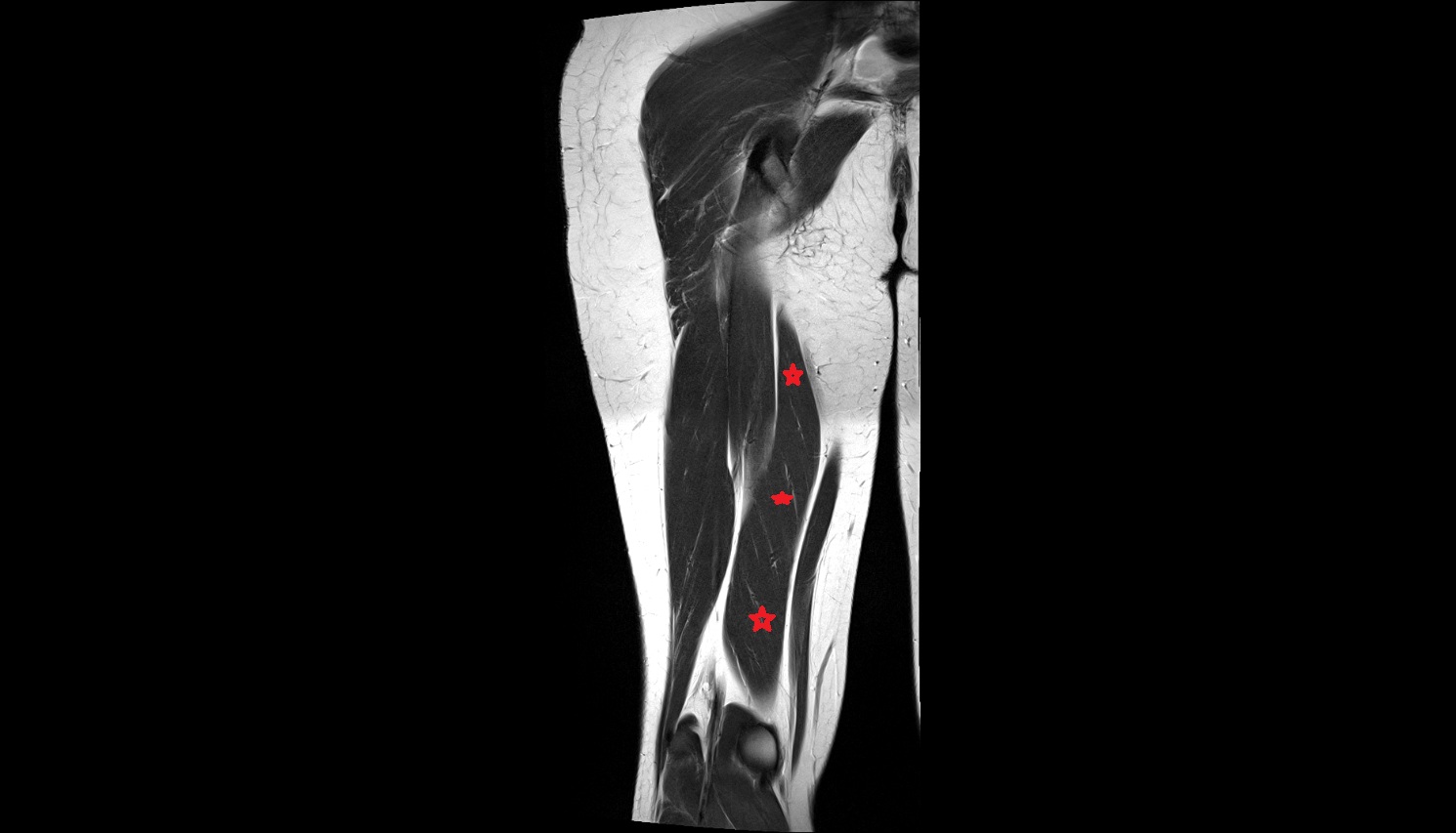 Semimembranosus muscle  MRI coronal anatomy image-img-00000-00000