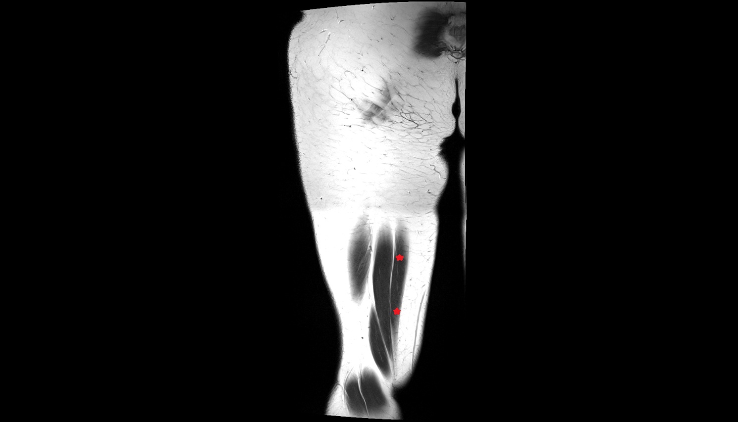 Semimembranosus muscle  MRI coronal anatomy image-img-00000-00000_00001