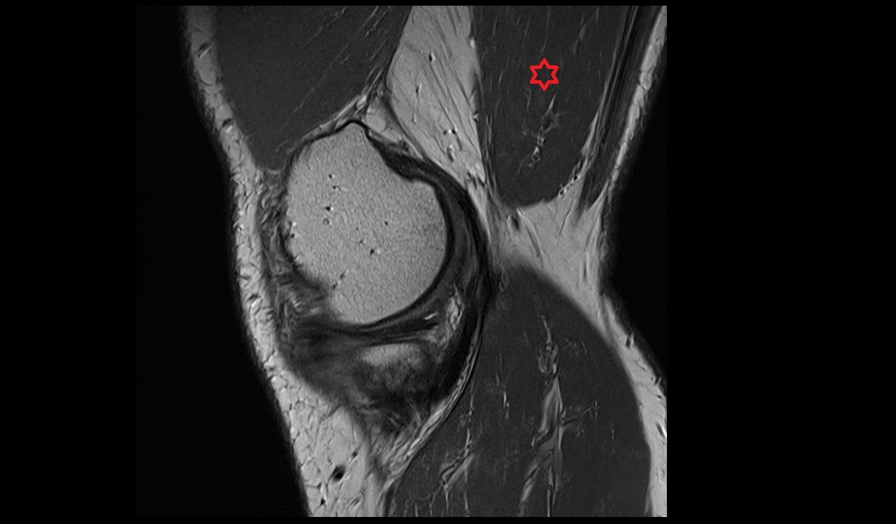 Semimembranosus muscle  image