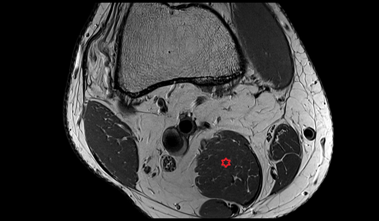 Semimembranosus muscle mri image